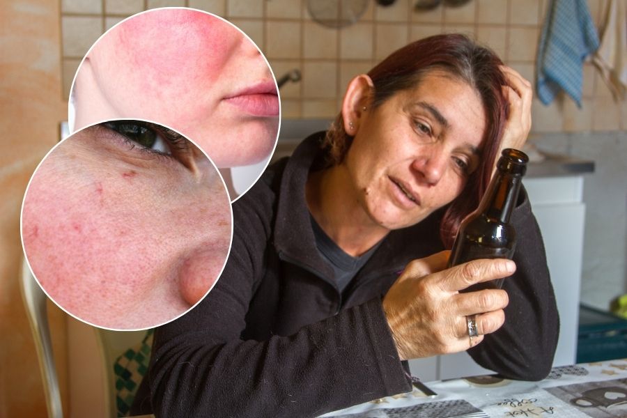 Effects of Alcohol on Facial Appearance